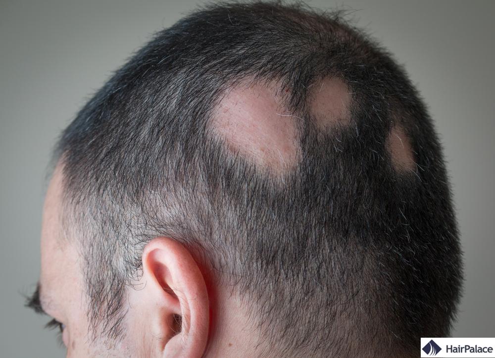 la pelade peut entraîner une perte de cheveux diffuse