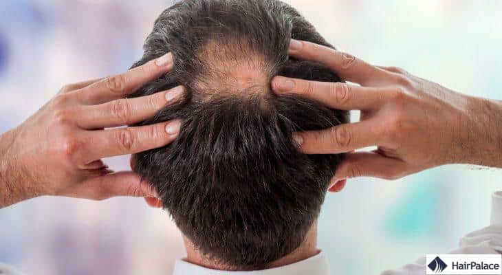 symptôme de la calvitie masculine