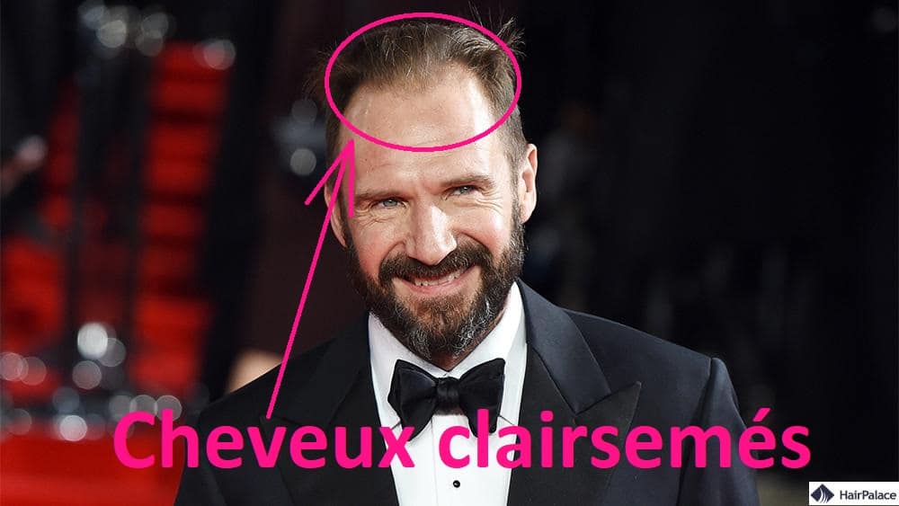 Ralph Fiennes calvitie masculine