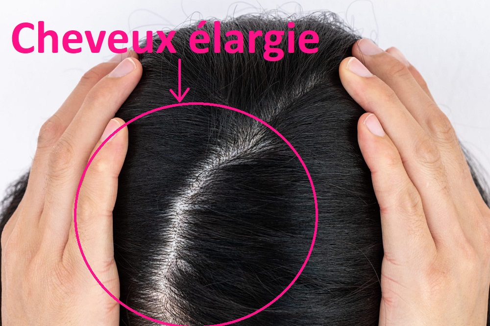 la perte génétique de cheveux peut entraîner un élargissement de la zone de cheveux qui s’éclaircissent