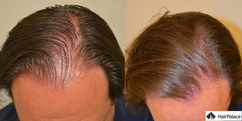 finasteride des photos avant et apres