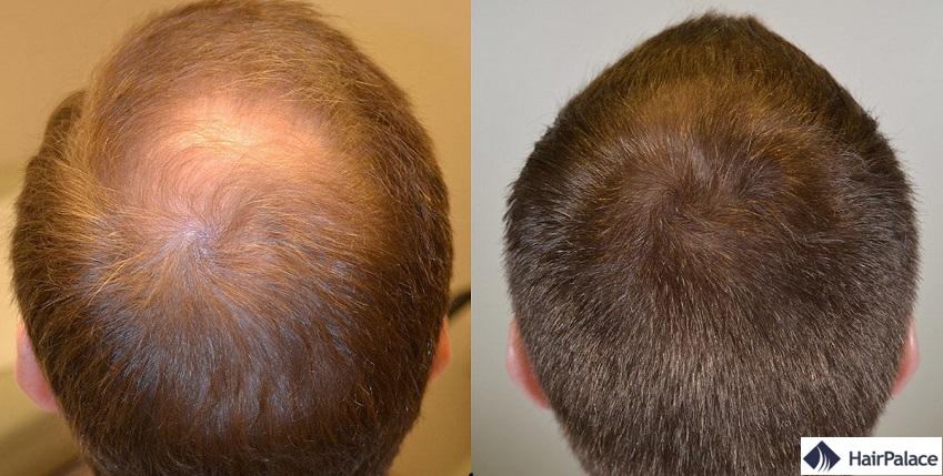 finasteride résultats