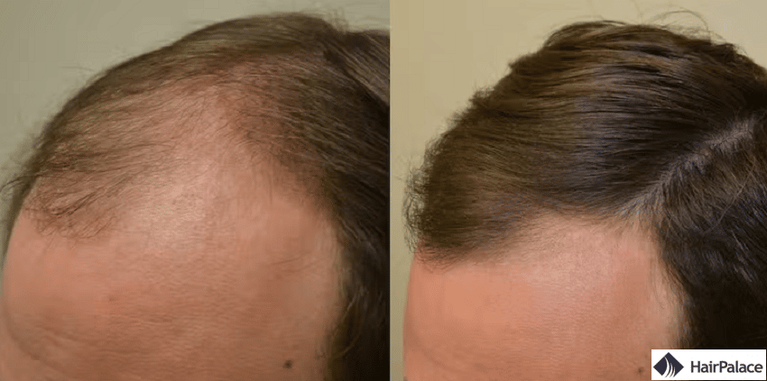 Finasteride avant et aprés