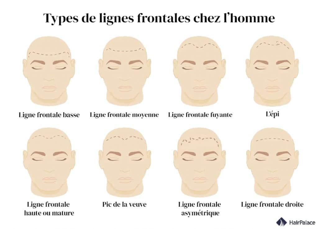 différents types de lignes frontales chez l’homme