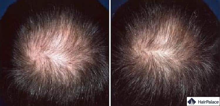 Rogaine pousse des cheveux résultat
