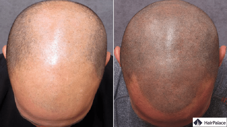 La micropigmentation (SMP) : avant et après