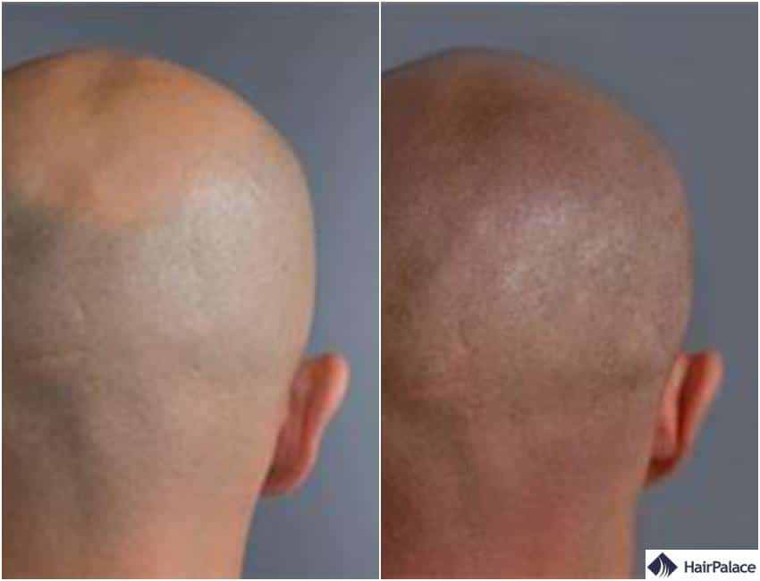 tatouage capillaire photos avant et après