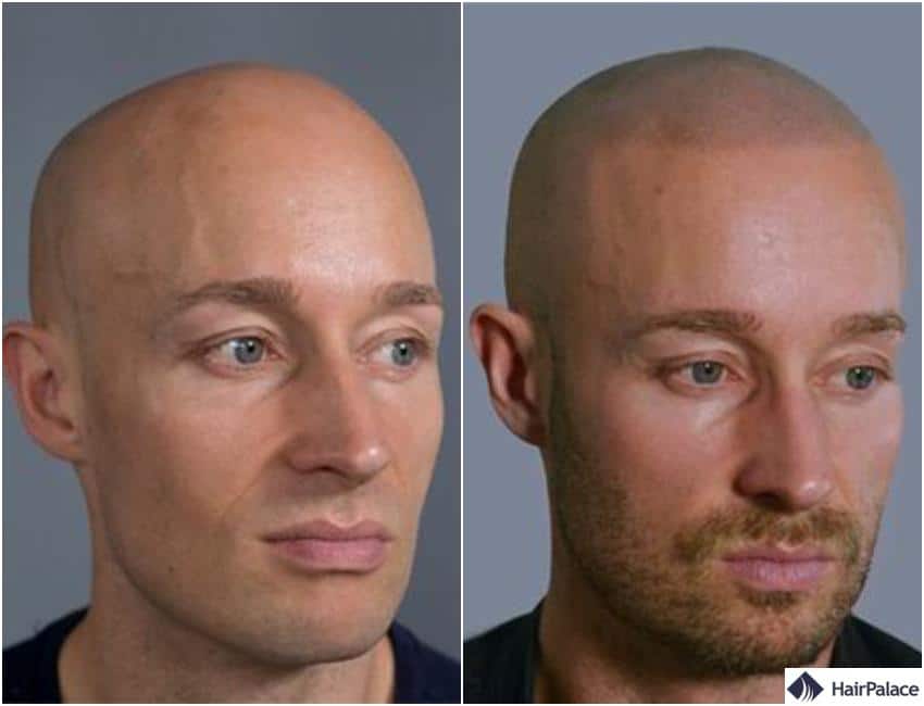 tatouage de cheveux résultats