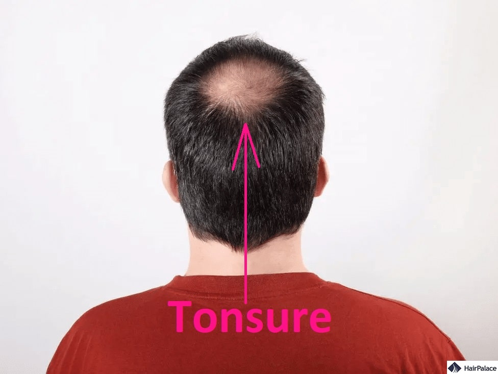 Calvitie de Tonsure | Comment la Dissimuler et Comment Arrêter