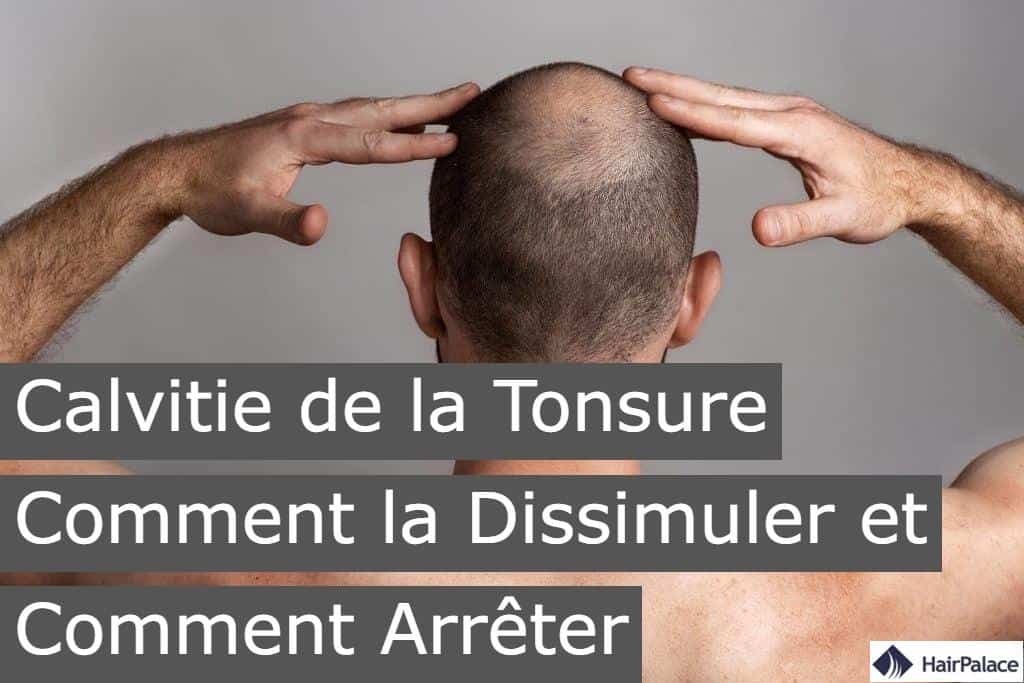 calvitie de la tonsure comment la dissimuler et comment arreter