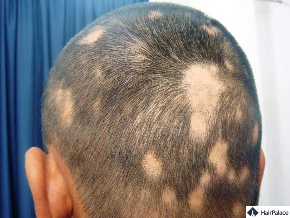 types de alopecia areata