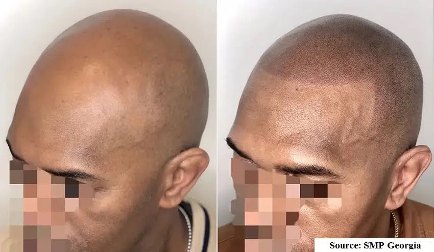 La tricopigmentation : avant et après