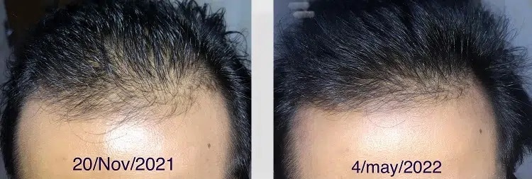 L’huile essentielle de romarin pour la croissance des cheveux : avant et après