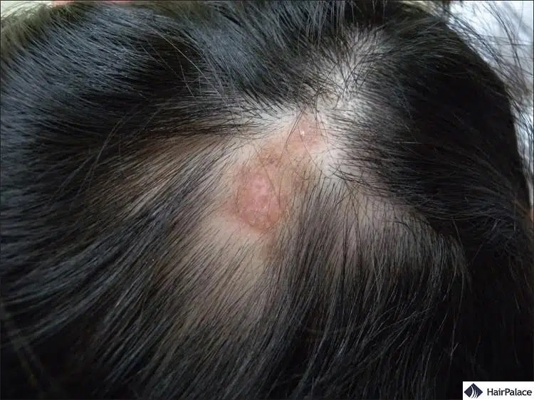 le lupus peut causer une perte de cheveux permanente