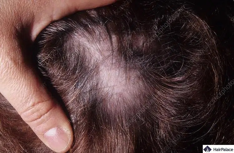 le lupus peut provoquer la chute des cheveux