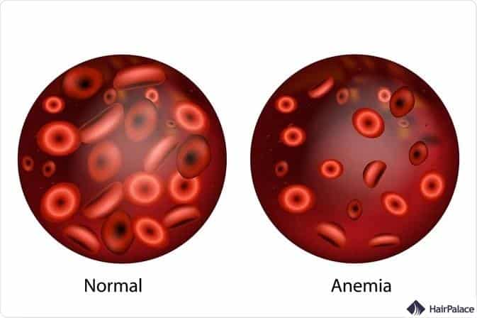 l'anémie peut entraîner une alopécie diffuse