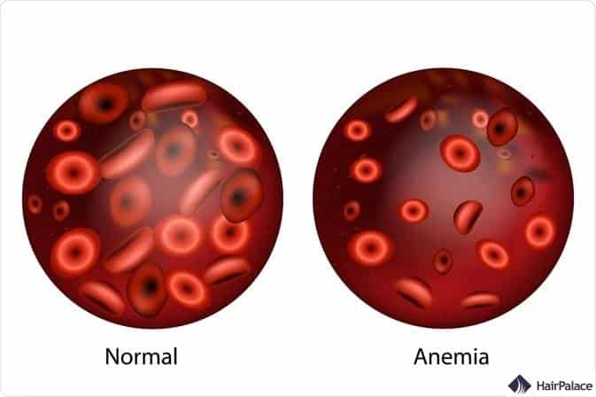 l'anémie la perte de cheveux est due à une carence en fer