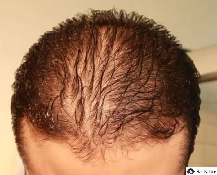 la perturbation du cycle de croissance des cheveux peut entraîner la chute des cheveux