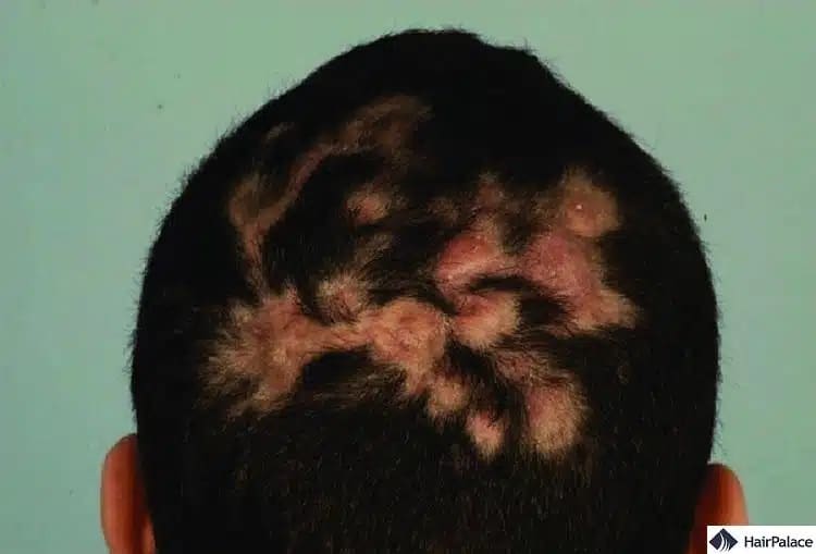 La folliculite est une maladie du cuir chevelu et une cause fréquente de perte de cheveux