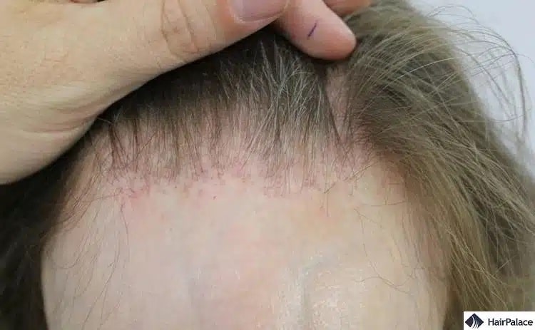 Le lichen plan est une maladie du cuir chevelu entraîner la chute des cheveux