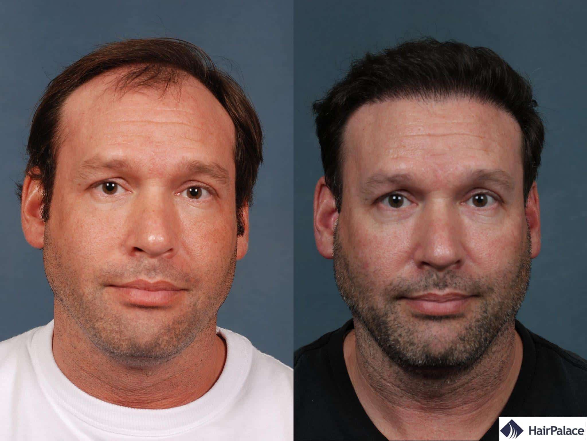 Greffe de cheveux Neograft résultats étonnants