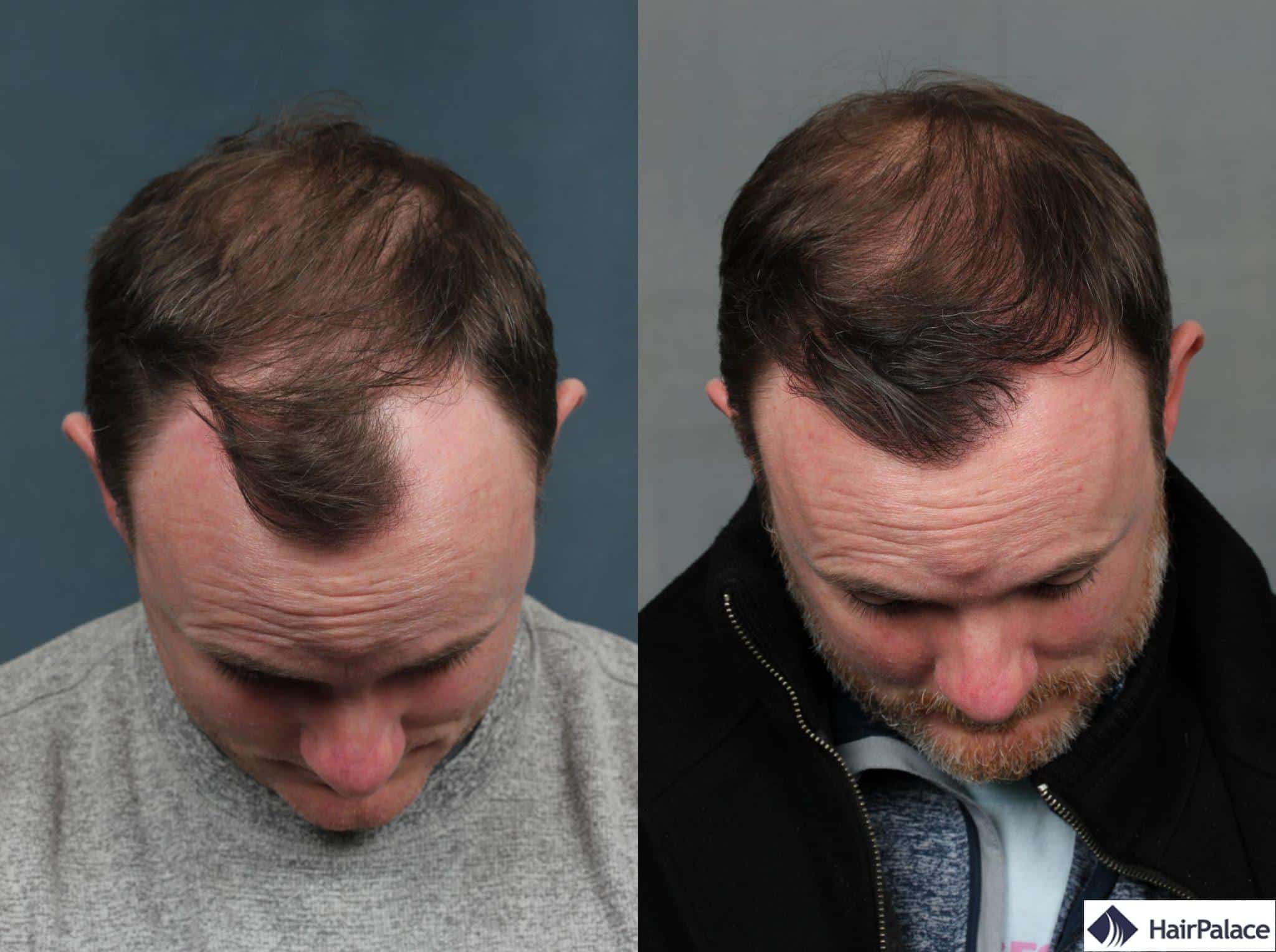Greffe de cheveux Neograft avant et après