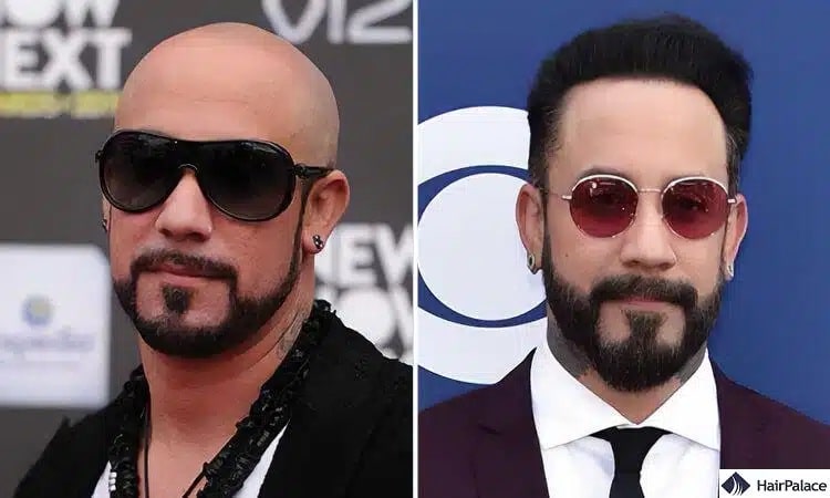 Greffe de cheveux AJ Mclean avant et après