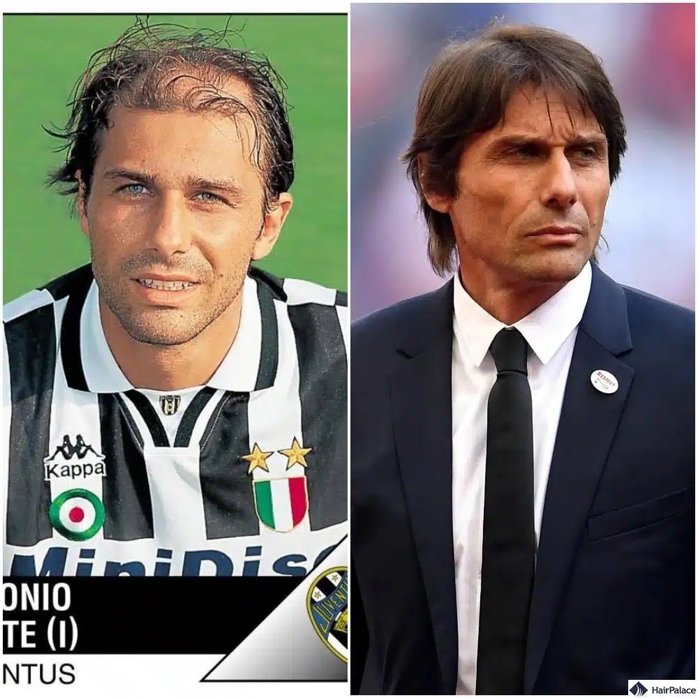 Greffe de cheveux Antonio Conte avant et après