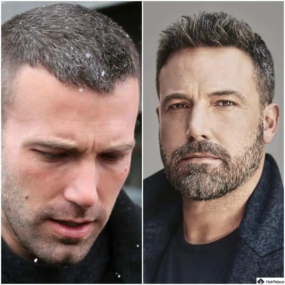 Greffe de cheveux Ben Affleck avant et après