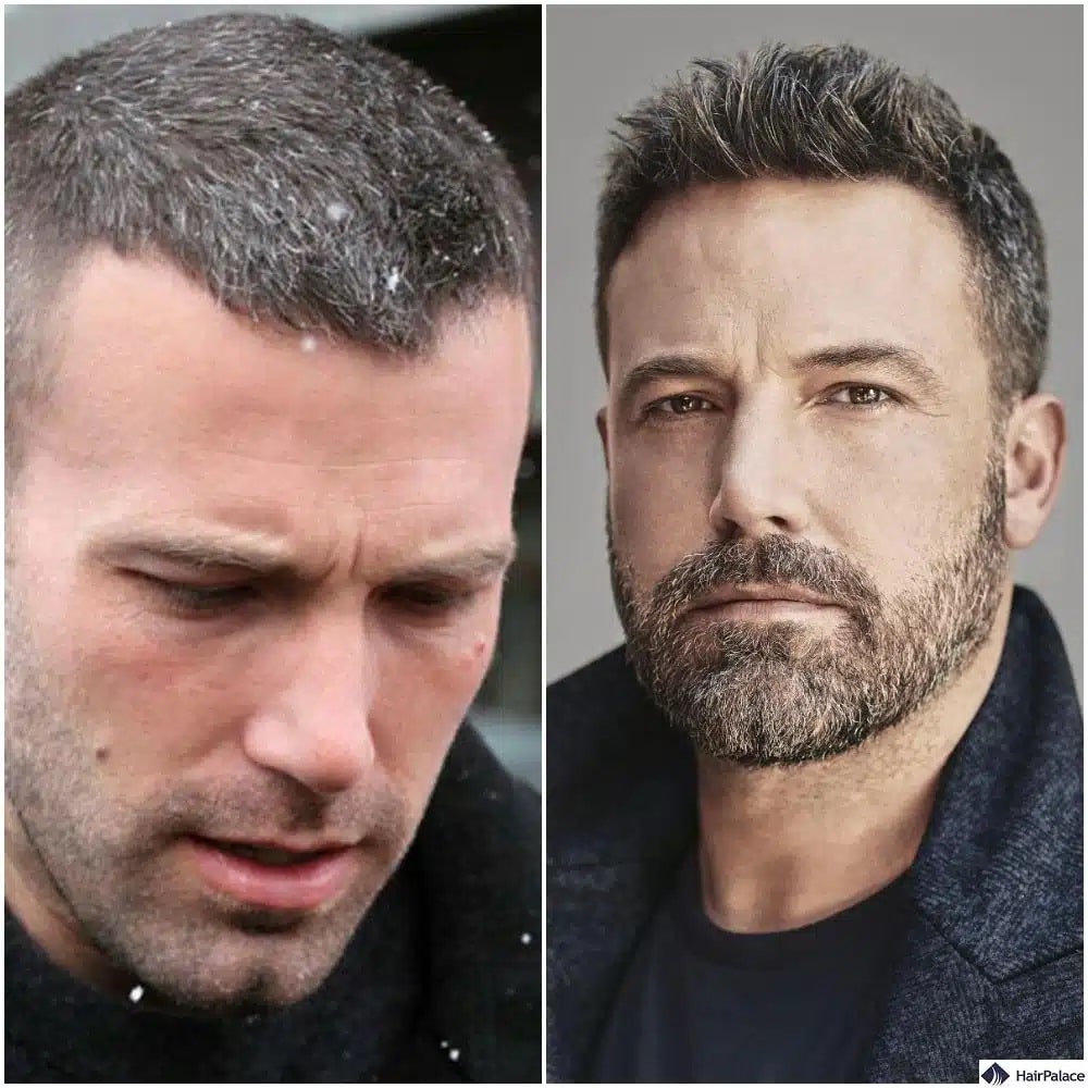 Greffe de cheveux Ben Affleck avant et après