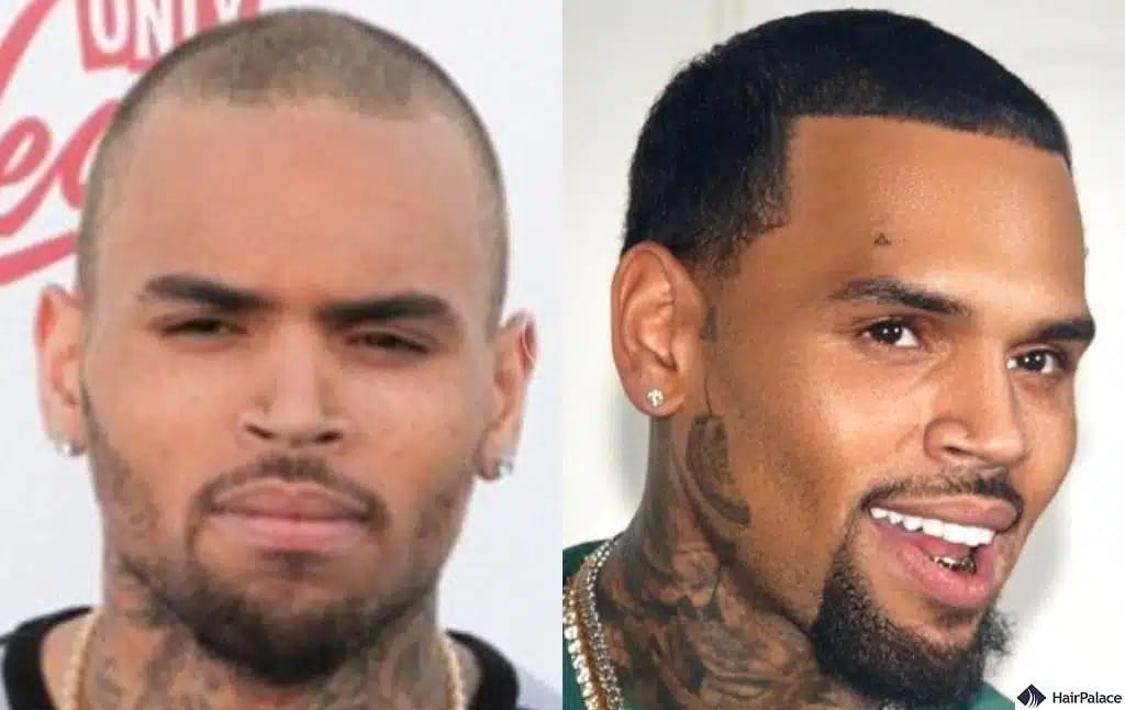 Greffe de cheveux Chris Brown avant et après