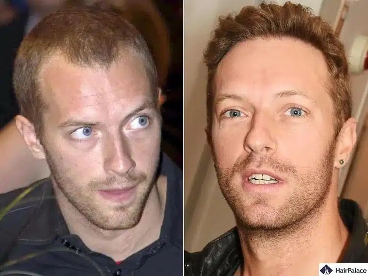 Greffe de cheveux Chris MARtin avant et après