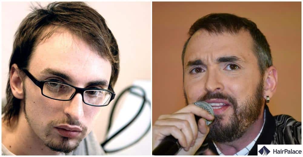 Greffe de cheveux Christophe Willem avant et après