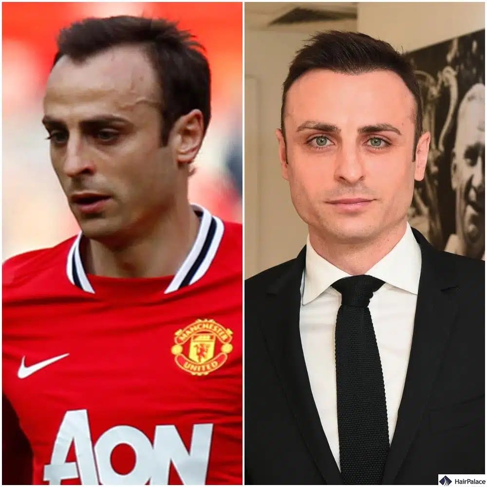 Greffe de cheveux Dimitar Berbatov avant et après