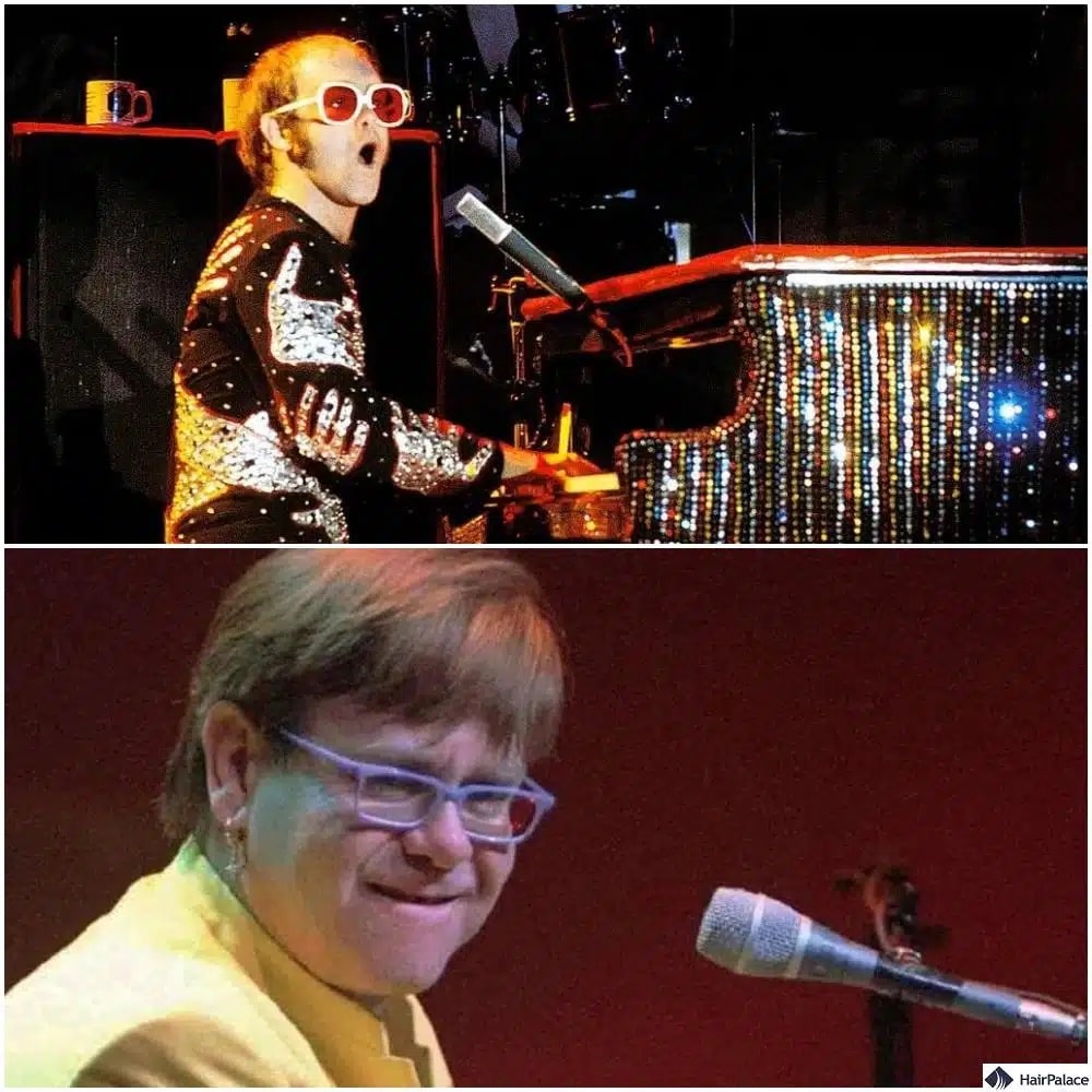 Greffe de cheveux Elton John avant et après
