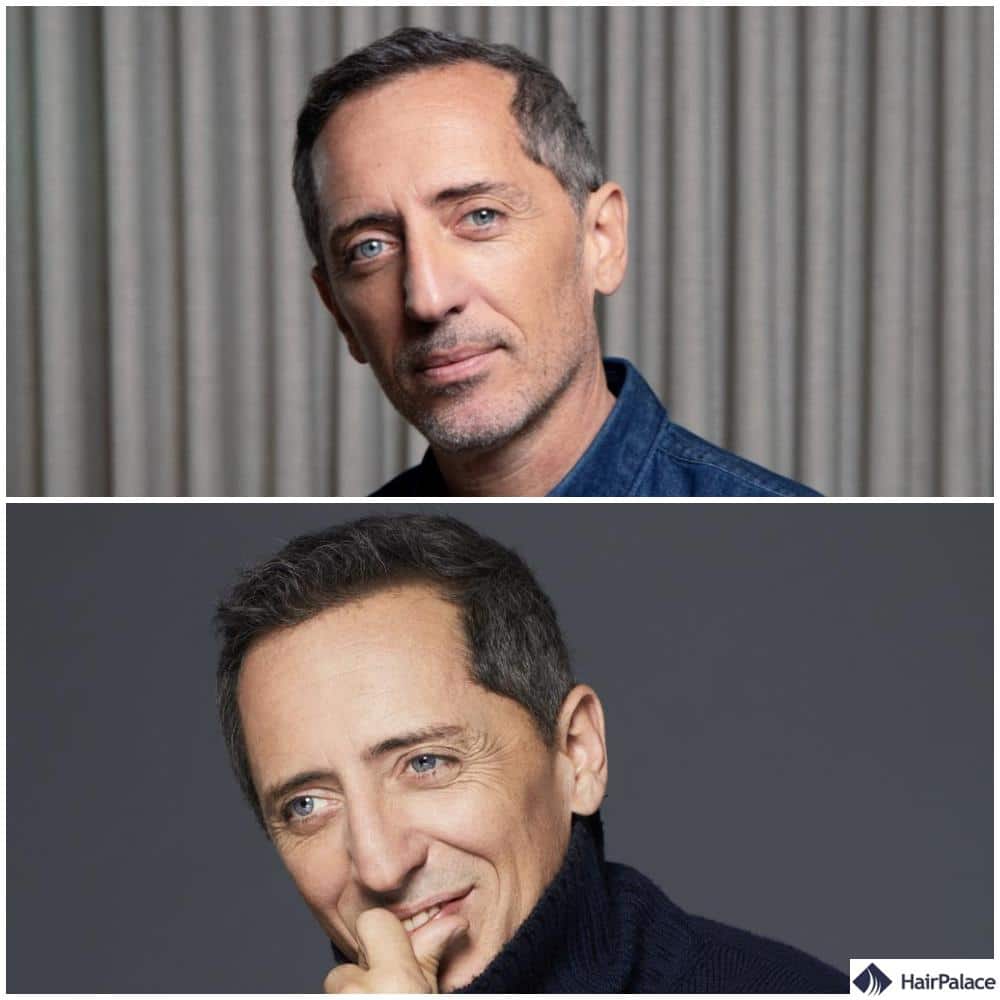 Greffe de cheveux Gad Elmaleh avant et après