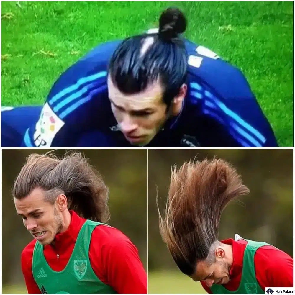 Greffe de cheveux Gareth Bale avant et après
