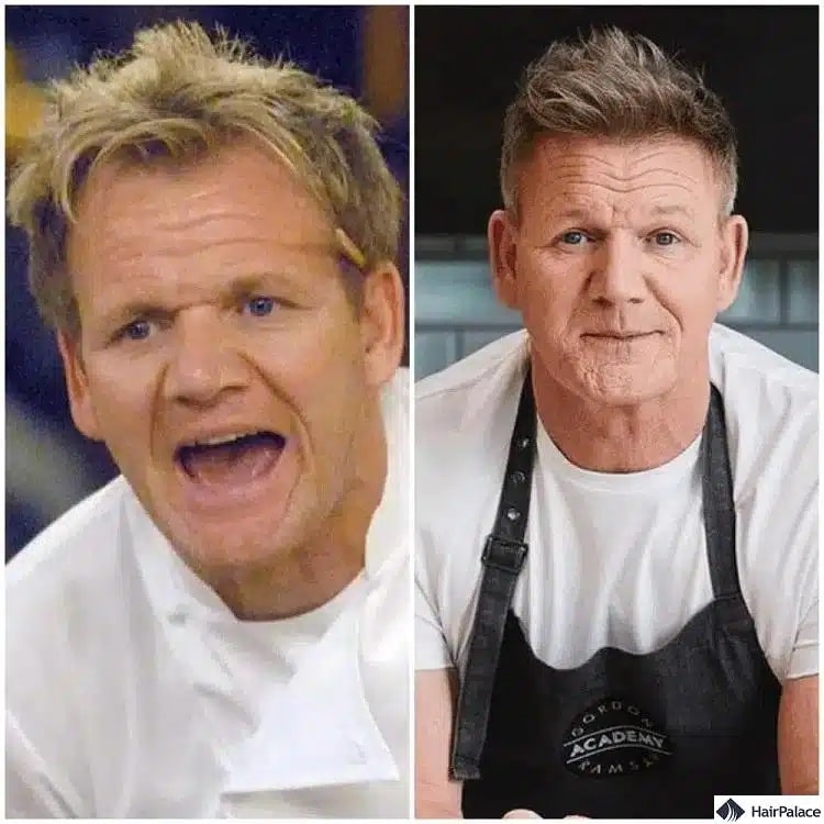 Greffe de cheveux Gordon Ramsay avant et après