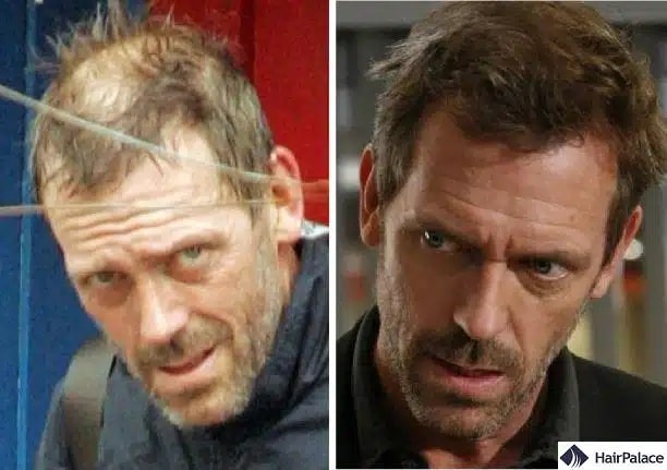 Greffe de cheveux Hugh Laurie avant et après
