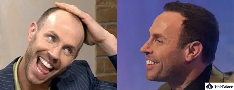 Greffe de cheveux Jason Gardiner avant et après