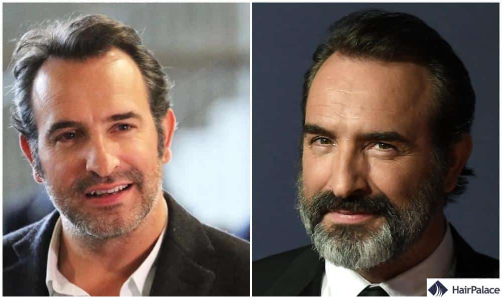 Greffe de cheveux Jean Dujardin avant et après