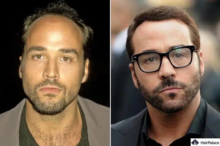 Greffe de cheveux Jeremy Piven avant et après