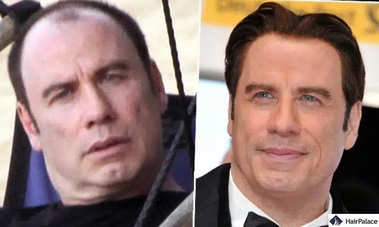 Greffe de cheveux John Travolta avant et après