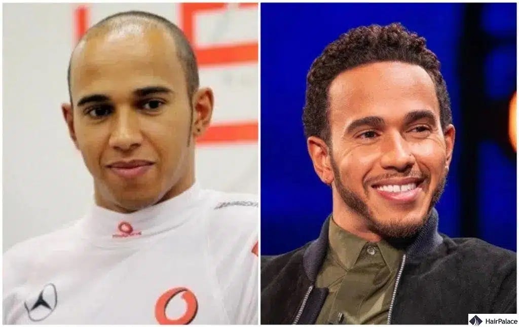 Greffe de cheveux Lewis Hamilton avant et après