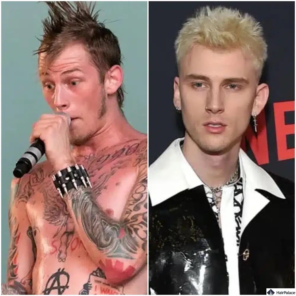 Greffe de cheveux Machine Gun Kelly avant et après