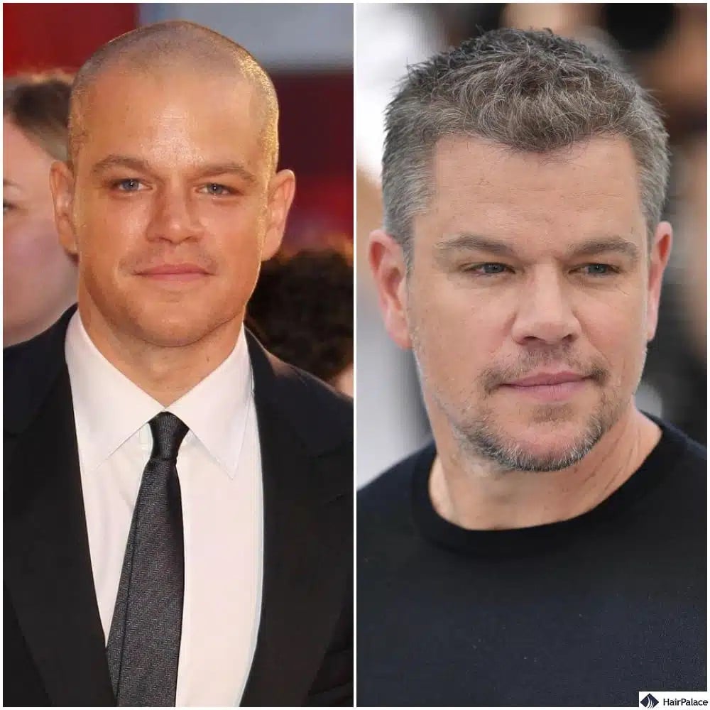 Greffe de cheveux Matt Damon avant et après