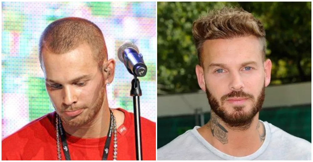 Greffe de cheveux Matt Pokora avant et après