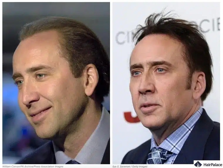 Greffe de cheveux Nicholas Cage avant et après