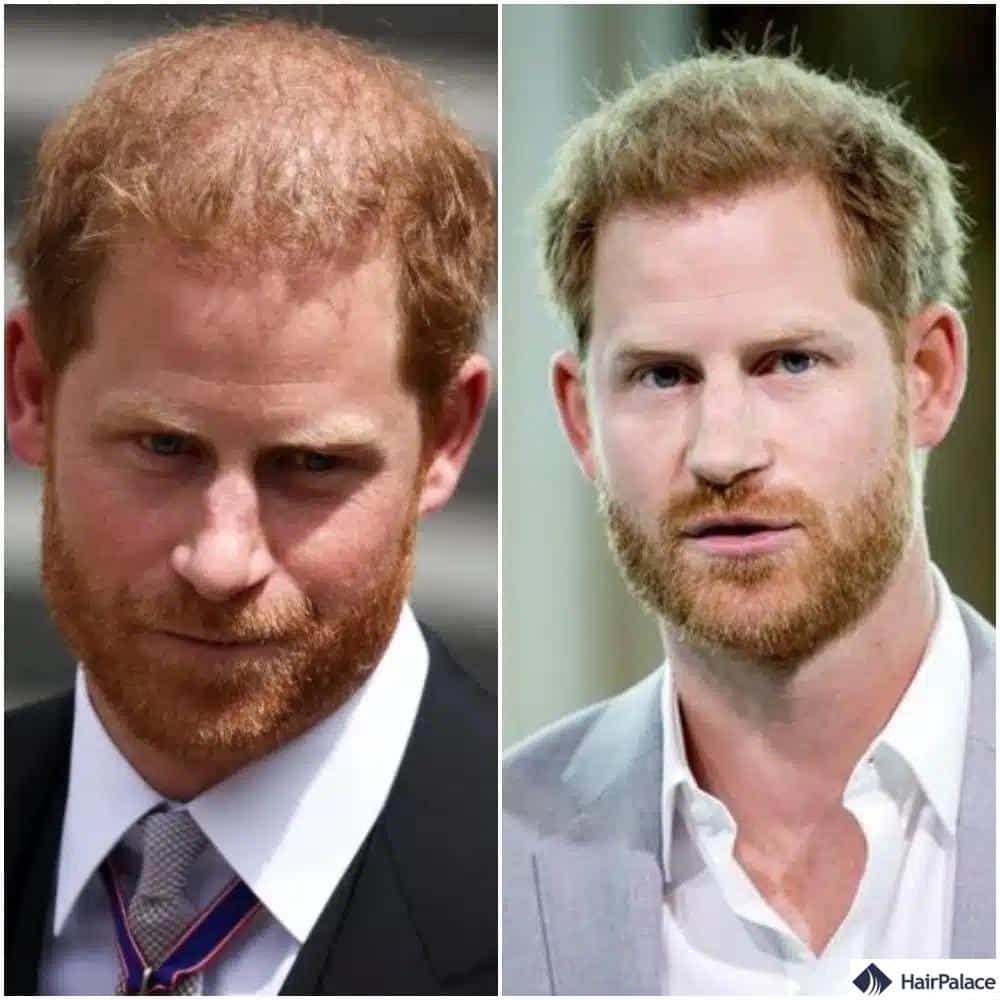 Greffe de cheveux du prince Harry avant et après