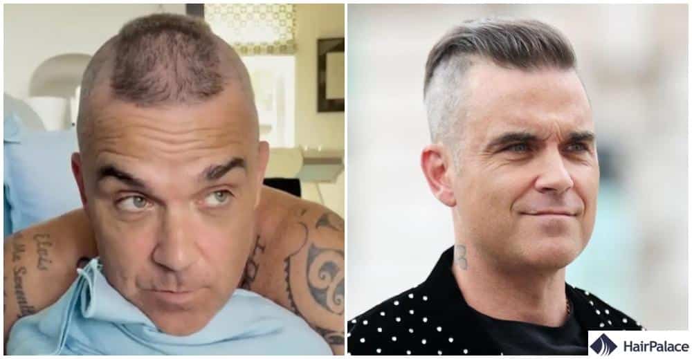 Greffe de cheveux Robbie Williams avant et après